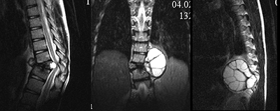 Опухоли позвоночника - лечение, симптомы, причины, диагностика | Центр Дикуля